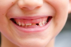 Baby Teeth Coming In Wrong Sequence