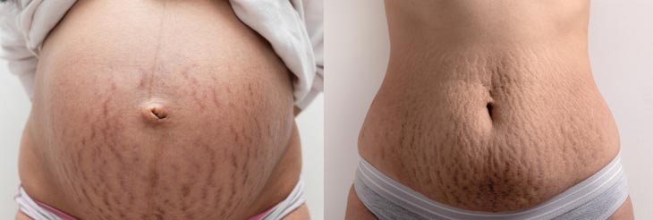 Belly And Thigh Stretch Marks