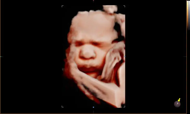 Why Does 3D Ultrasound Wide Nose Happen