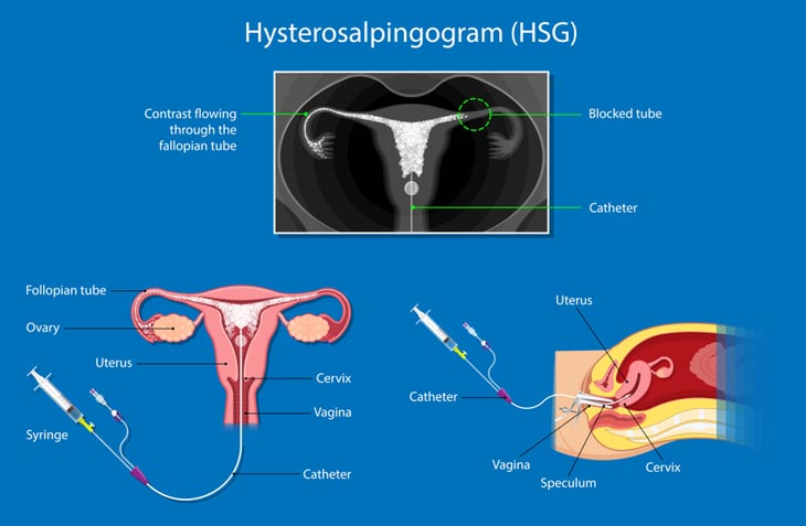 Does Early Ovulation Occur After HSG