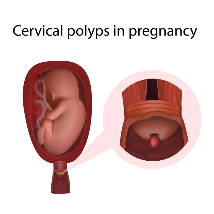 Pregnant With Polyps