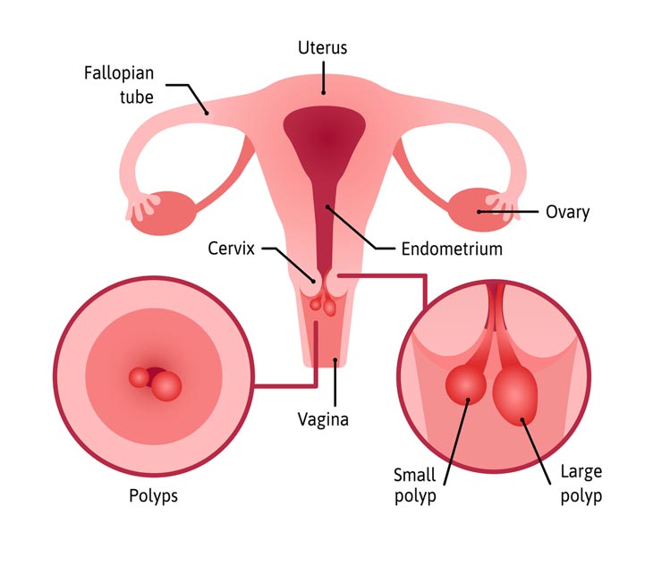 What Are Polyps