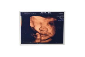 baby with big lips on ultrasound