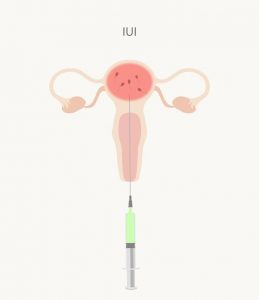What Not To Do After IUI?