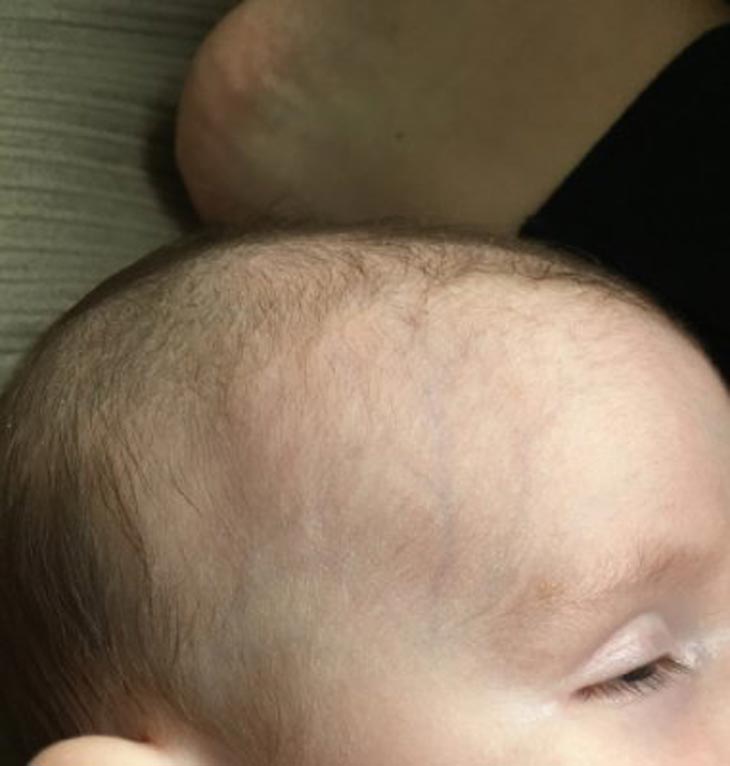 child veins showing through skin on face