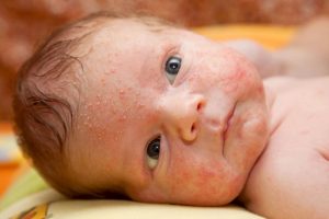 Overview Of Baby Acne