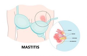 Possibilities Of Getting Cancer When Having Red Spots On Breast