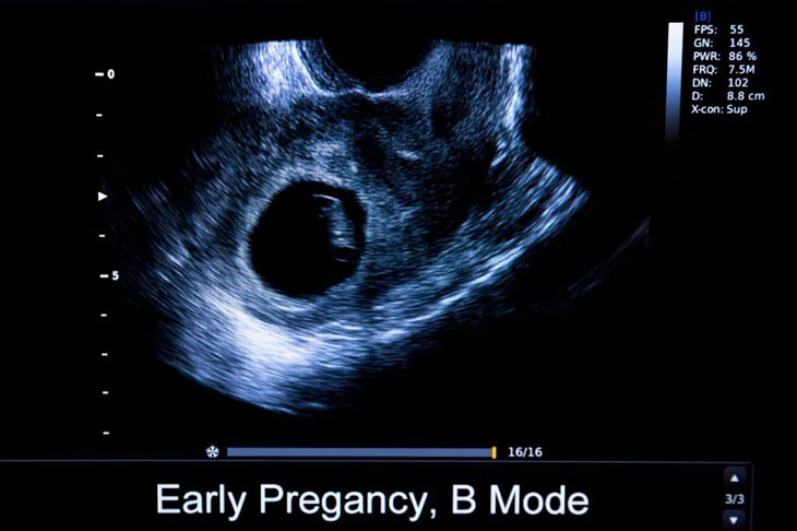 Empty Sac At 6 Weeks