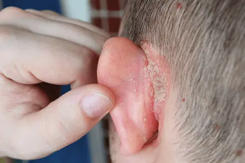 Yeast Infection Behind Baby's Ear