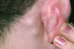 what causes yeast infection behind the ear