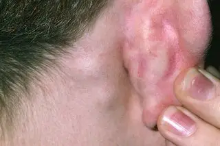 Yeast Infection Behind Baby’s Ear: Causes And Solutions