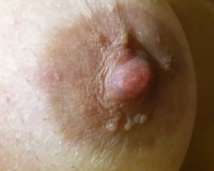 Skin Tag On Areola During Pregnancy