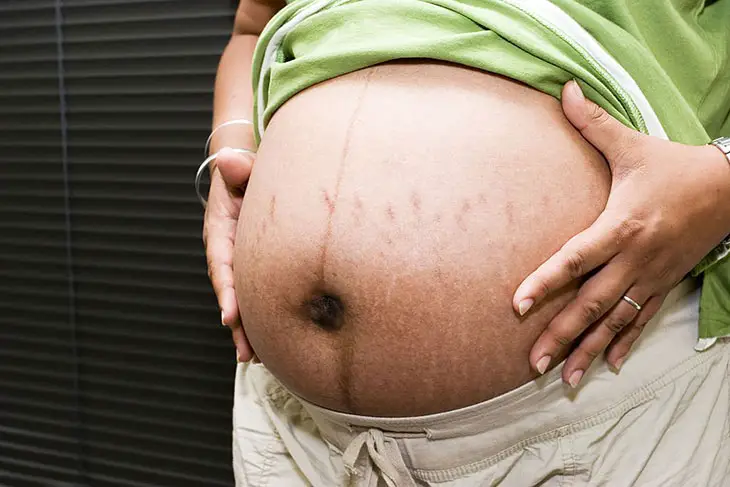 Herniated Stretch Mark