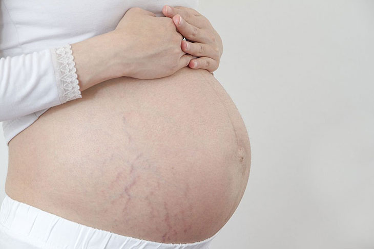 Herniated Stretch Mark – Causes, And What To Do About It