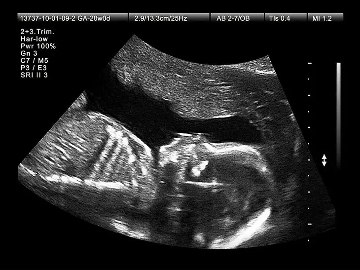 20 week scan couldn't measure heart