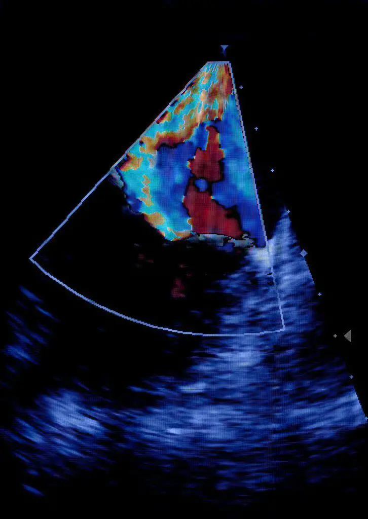 Is it normal to not get all measurements at 20-week scan