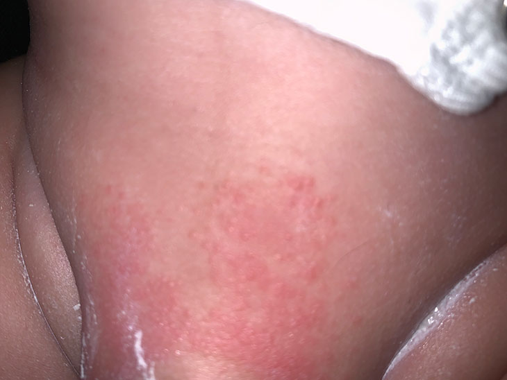 red spots diaper rash