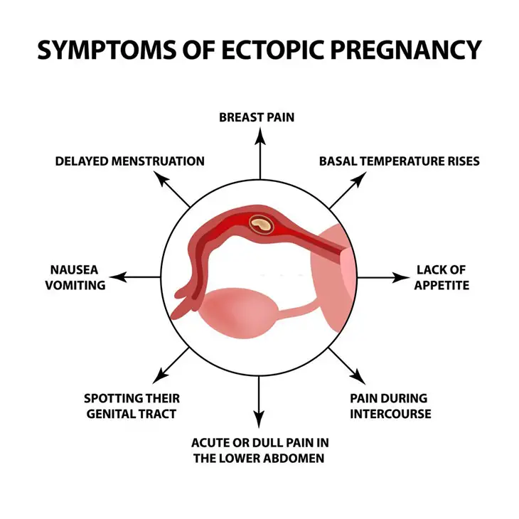 Ectopic Pregnancy