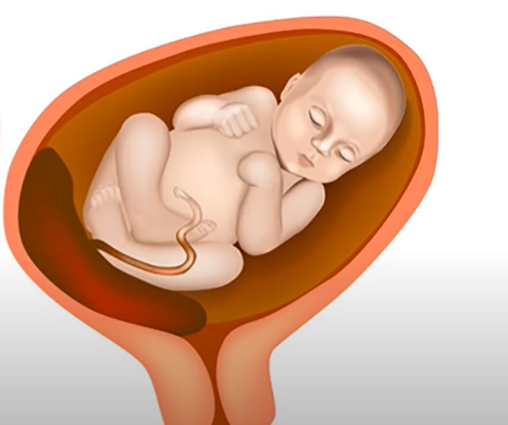 amniotic fluid in urine