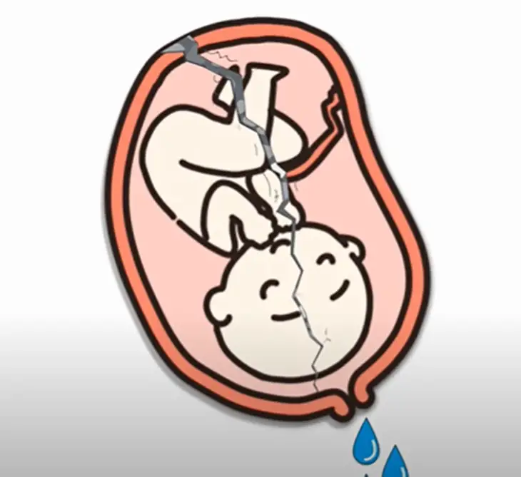 can-you-leak-amniotic-fluid-if-your-cervix-is-closed-solved