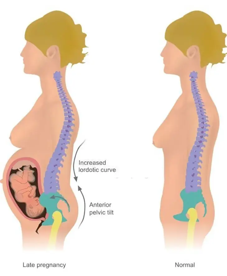 sciatica pain during pregnancy gender prediction