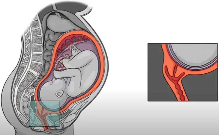 how long labor after induction