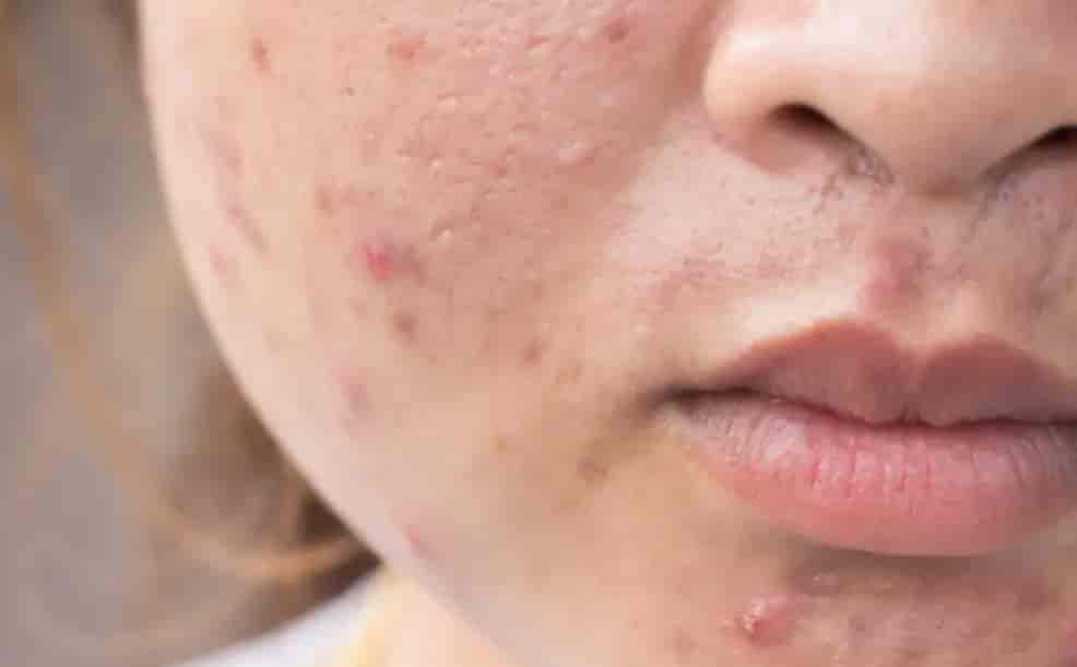 When Does Pregnancy Acne Begin